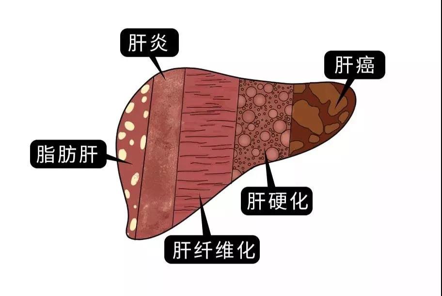 脂肪肝的最大敵人不是肥胖，答案竟是這樣！