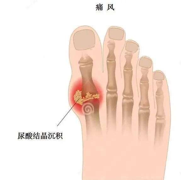 痛風為什么偏愛男性？你最關心的問題都在這里