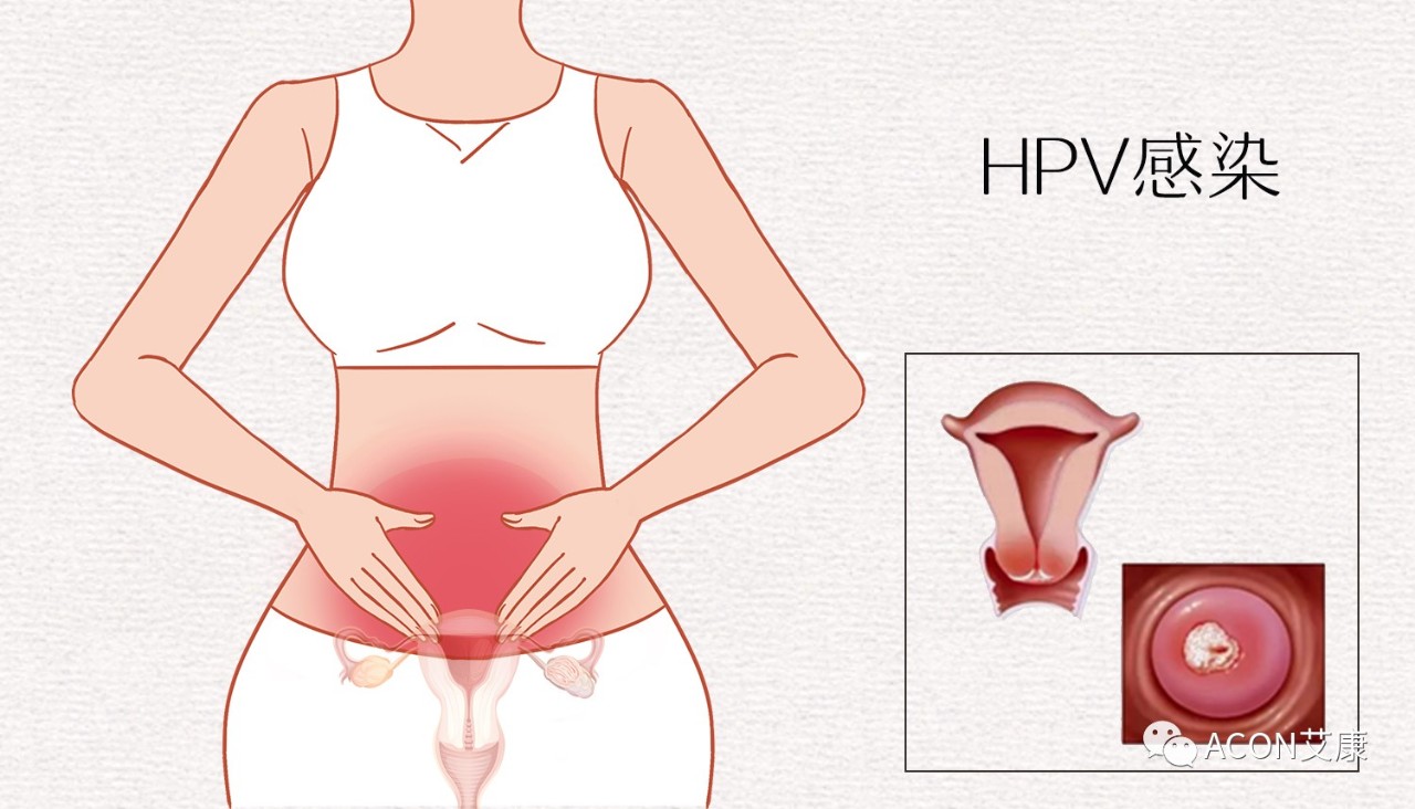 HPV轉(zhuǎn)陰其實很簡單， 女性必知的宮頸癌真相