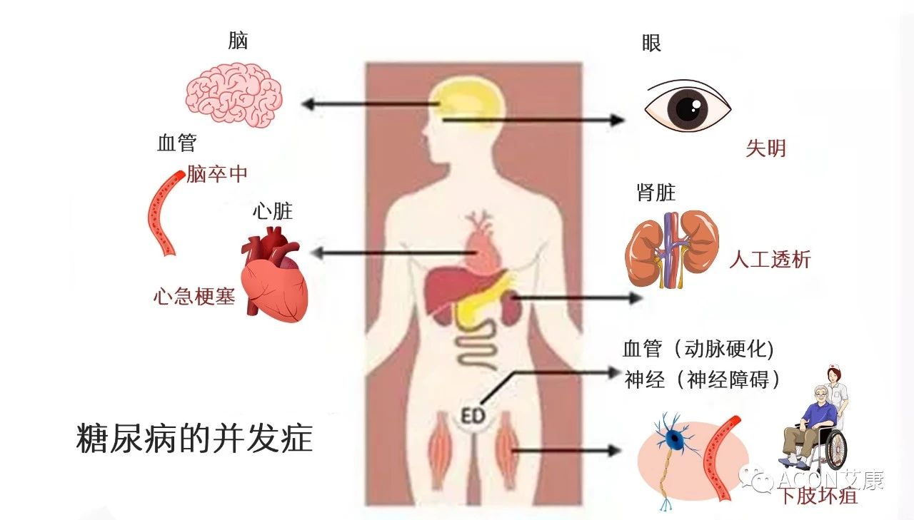 爆上熱搜，因爆發(fā)型糖尿病進(jìn)入ICU，有哪些教訓(xùn)值得我們汲取