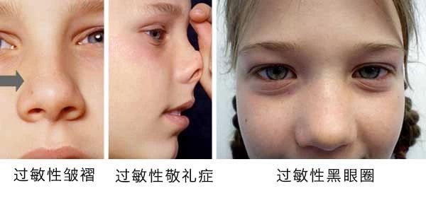 過敏性鼻炎會讓孩子變傻？！家長該如何應對